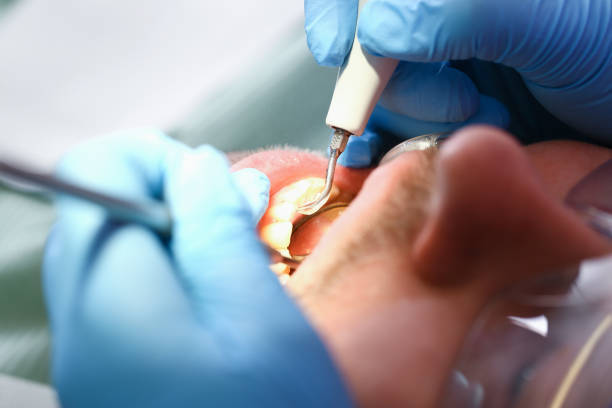 Best Emergency Root Canal Therapy in Camas, WA
